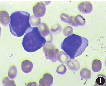 1例慢性粒细胞白血病急髓变患者骨髓细胞形态学检查结果瑞特-吉姆萨×1 000