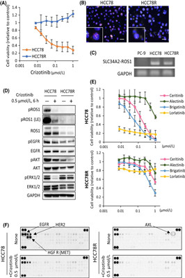 卡博替尼与吉非替尼联合应用于ROS1融合克唑替尼耐药肺癌