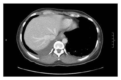 继发于克唑替尼治疗的重度食管炎：肺癌患者用药后千万不要这样做