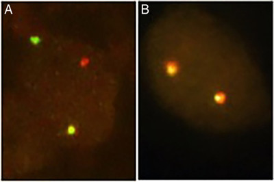 克唑替尼治疗ROS1重排非小细胞肺癌：从反应到耐药