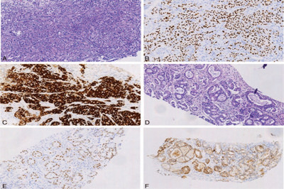 克唑替尼治疗出现附件转移的ALK重排肺腺癌患者：病例报告