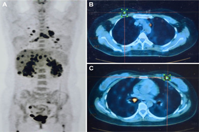 克唑替尼成功治疗ALK阳性非小细胞肺癌伴双侧乳腺转移