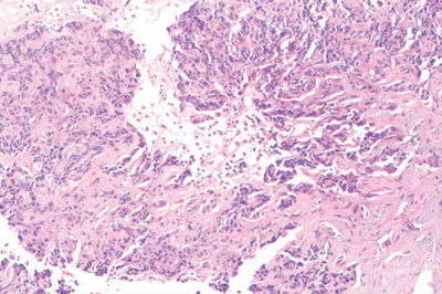 曲美替尼+达拉非尼治疗BRAF V600E突变胆管癌：个性化精准医疗