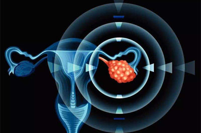奥拉帕尼可治疗晚期卵巢癌