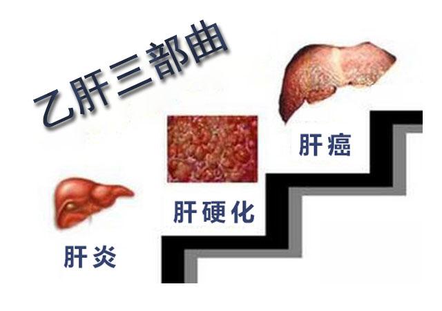 乙肝抗病毒治疗