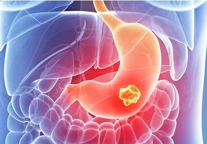 胃肠道间质瘤图片